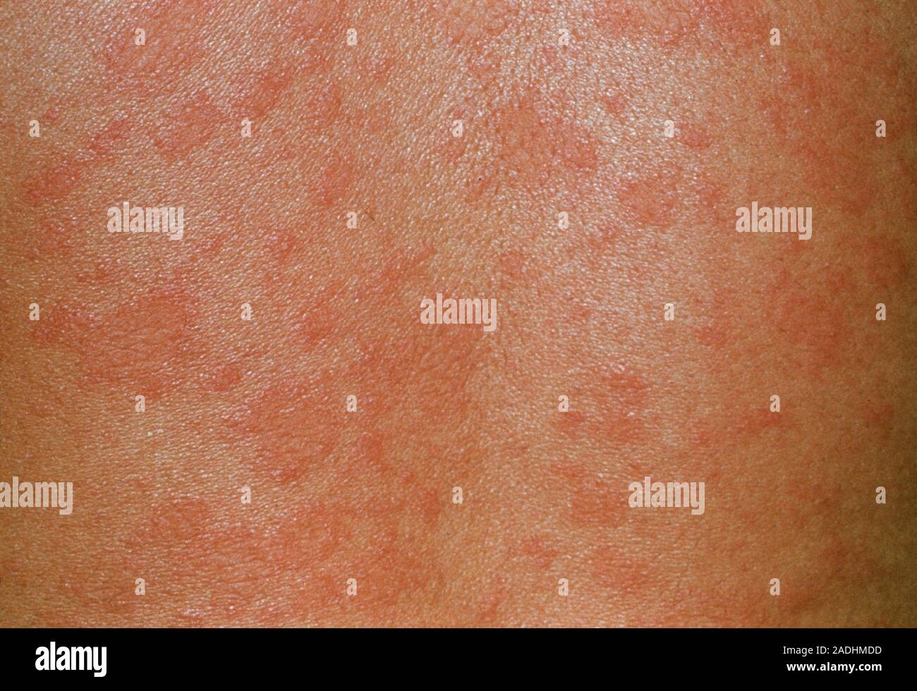 Pityriasis rosea skin rash. This skin disorder is thought to be viral in origin. It starts with a single herald" patch that is followed, around 1-2 Stock Photo