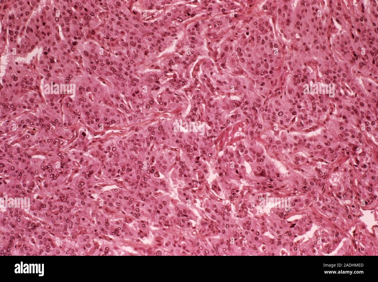 Adrenal Gland Tumour. Light Micrograph Of A Section Through A Human 