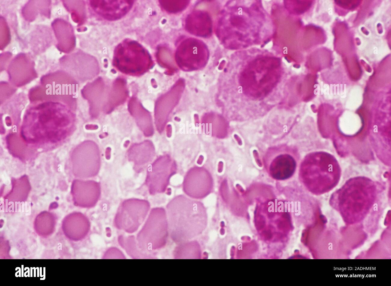 Bacterial pneumonia infection. Light micrograph of pneumonia bacteria (Klebsiella pneumoniae, rod- shaped, pink) among cells in a sample of pus from a Stock Photo