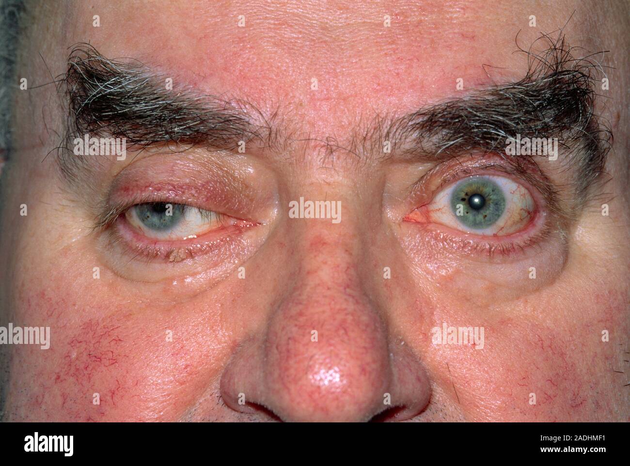 Facial palsy. Closeup of the eyes of a 67 year old man showing a