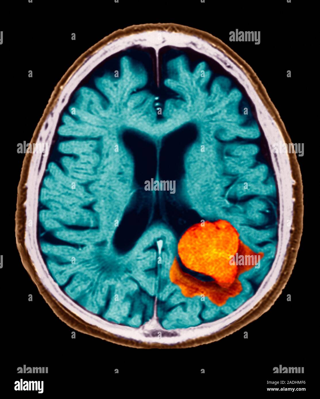 Brain lesion. Coloured axial (horizontal) resonance imaging