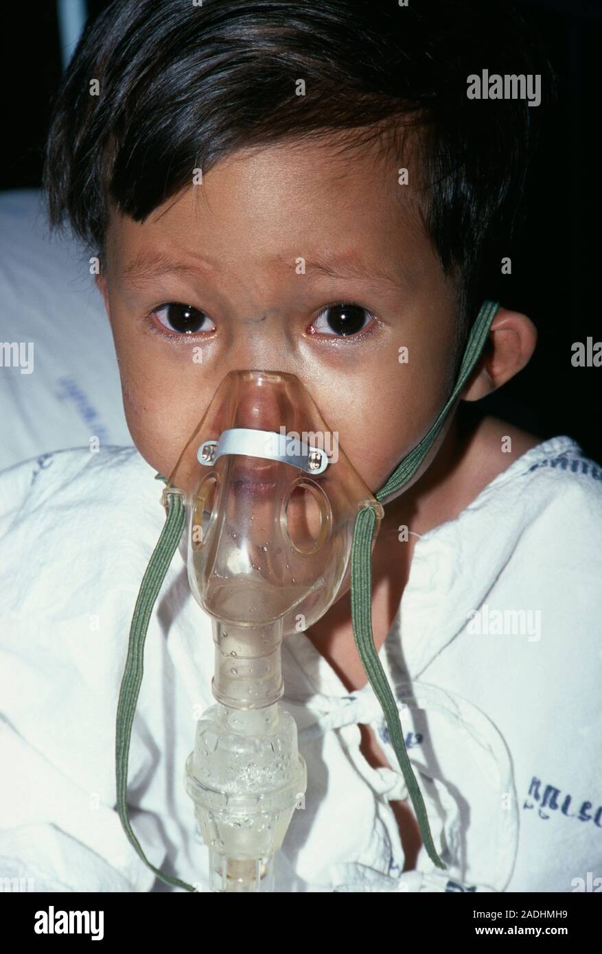 Secondary pneumonia infection. 2yearold boy who is wearing a