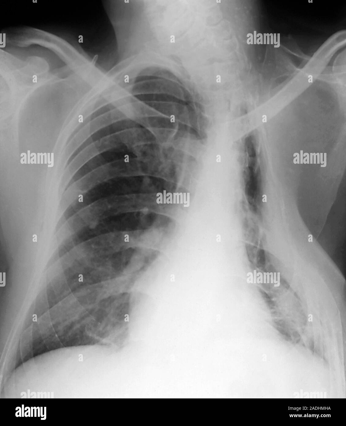 Pleurisy of the lungs. Frontal Xray of a patient's chest showing pleurisy, inflammation of the