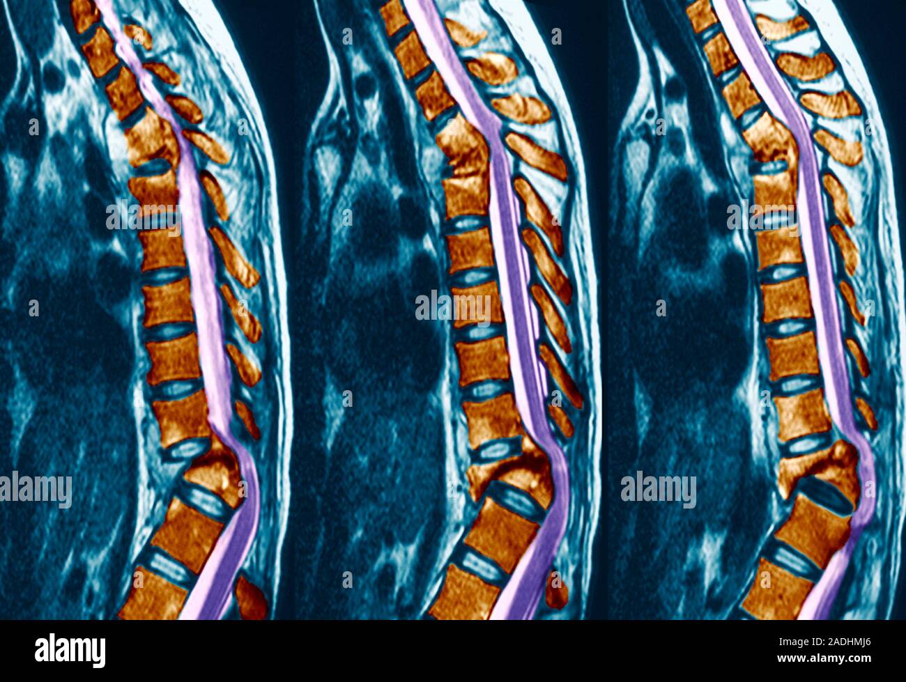 Pott's disease. Coloured magnetic resonance imaging (MRI) scans of sagittal (side) sections through the spine of a patient with Pott's disease (tuberc Stock Photo