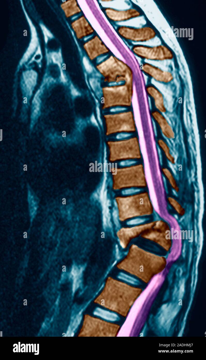 Pott's disease. Coloured sagittal (side) section resonance