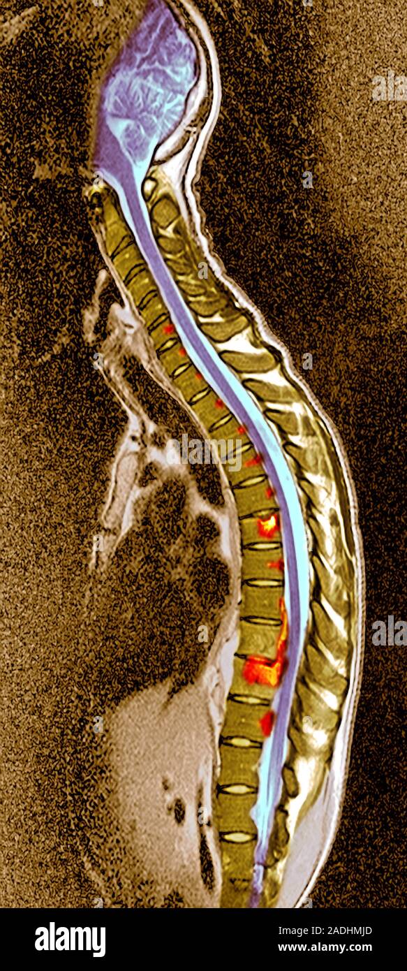 Pott's disease. Coloured Xray of the spine of a patient with Pott's