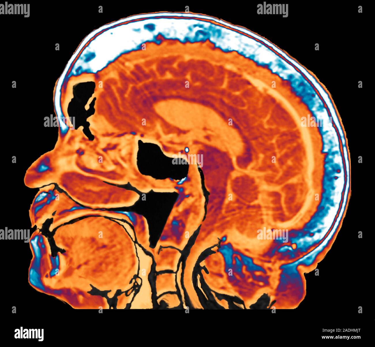 Paget's disease. Coloured resonance imaging (MRI) scan of a