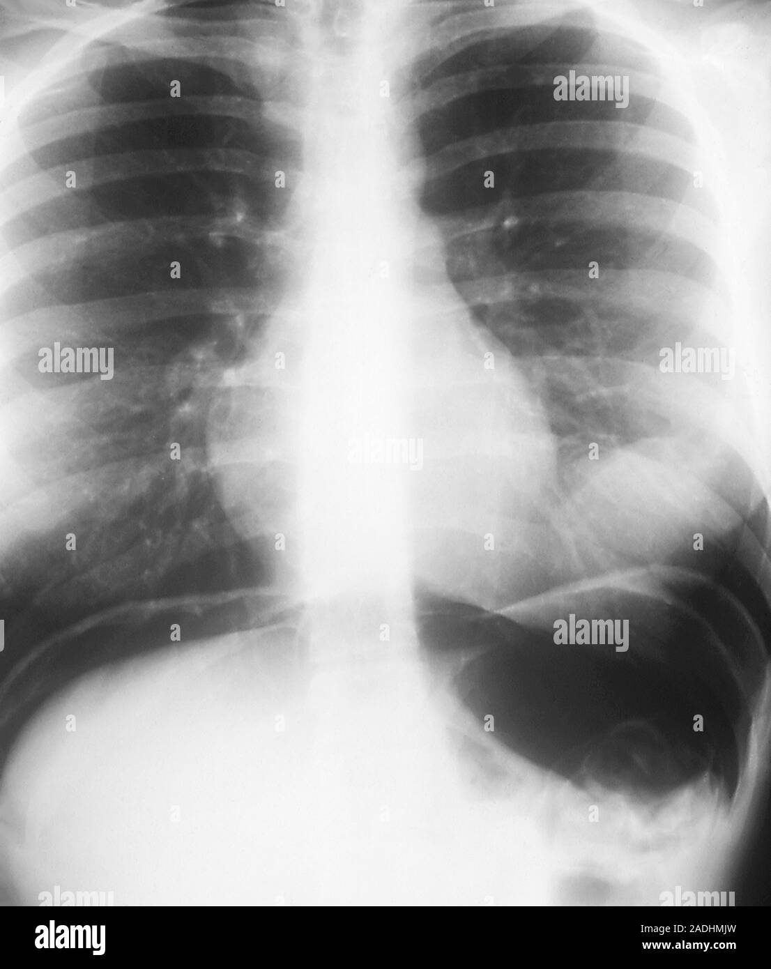 Abdominal air pockets. Xray showing air in the abdomen, dark masses