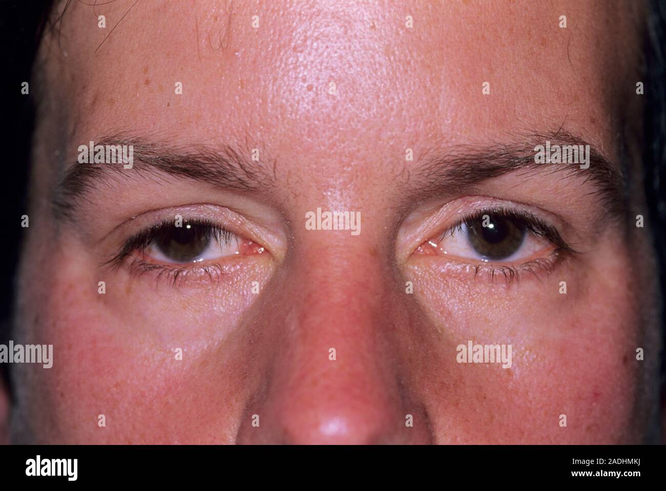MODEL RELEASED. Droopy eyelid. 35yearold man with ptosis (droopy