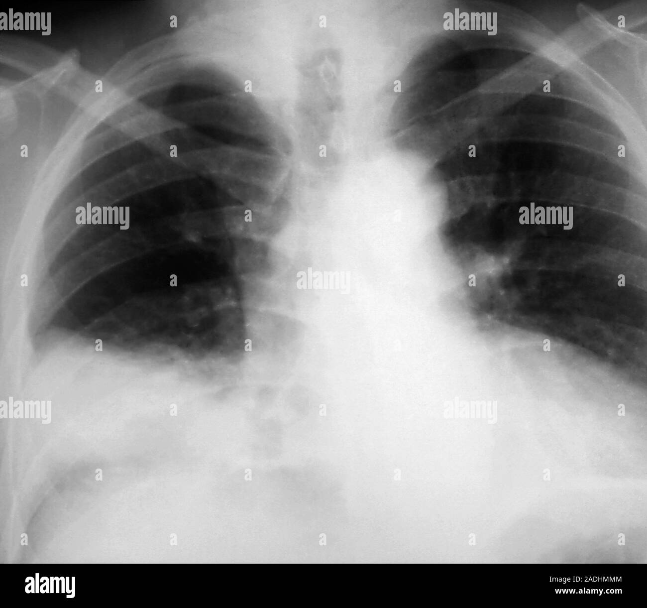 Pneumonia. Xray of the chest of a patient with bacterial pneumonia