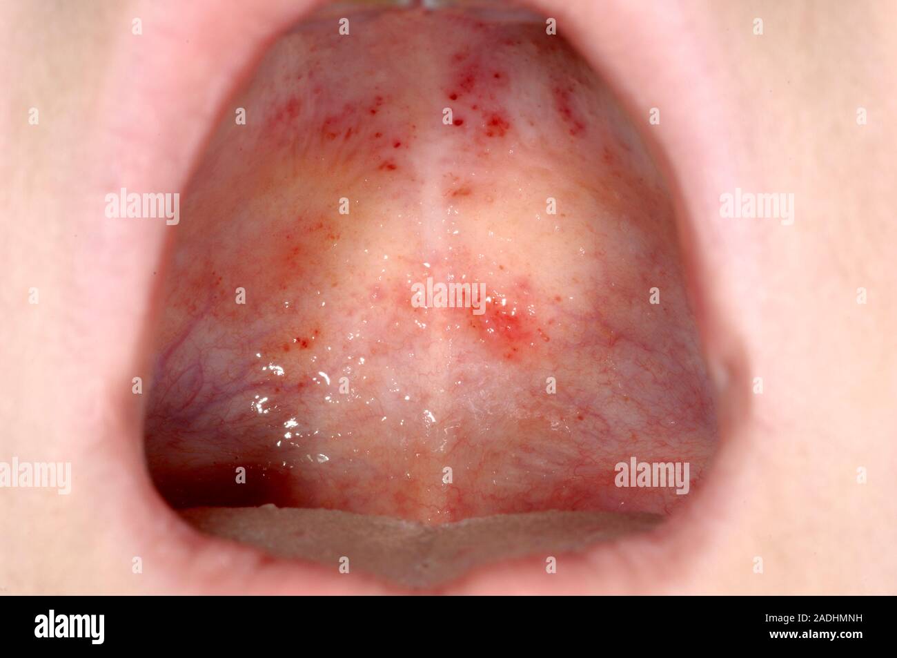 Petechial rash on the of a 6 year old girl's mouth. These small spots (petechiae) are due to minute haemorrhages and are a complication of a vira Stock Photo - Alamy