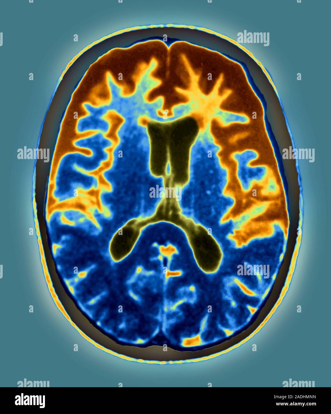 Pick's disease. Coloured axial resonance imaging (MRI) scan of