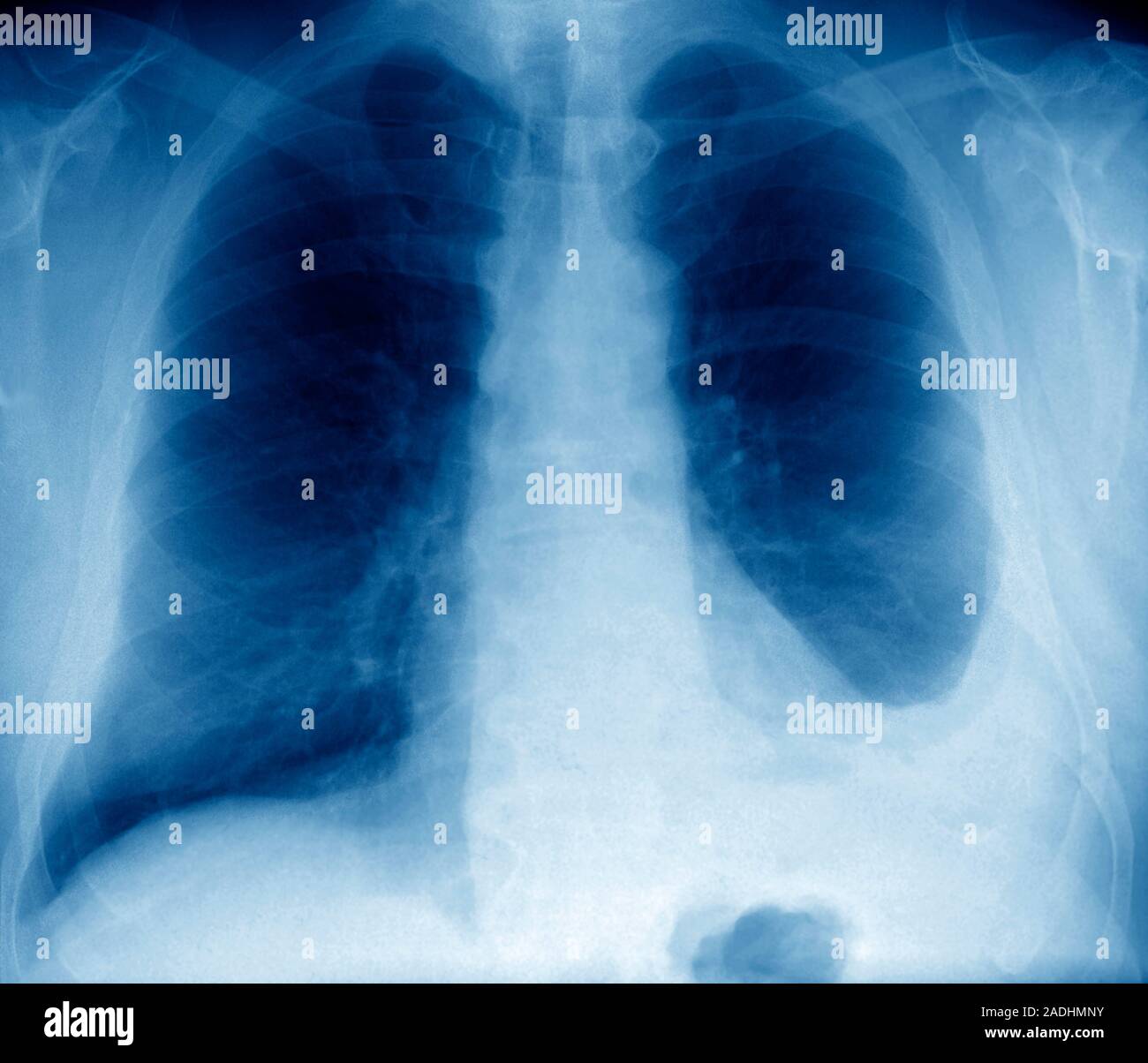 Pleural effusion. Coloured frontal Xray of the lungs of a 60yearold patient with a pleural