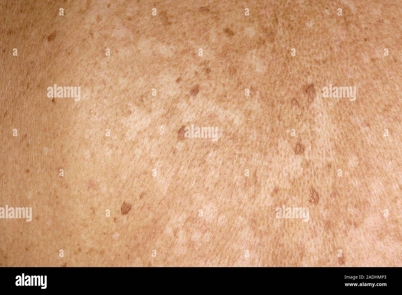 Pityriasis versicolor. Light areas on the skin of a 71 year old man