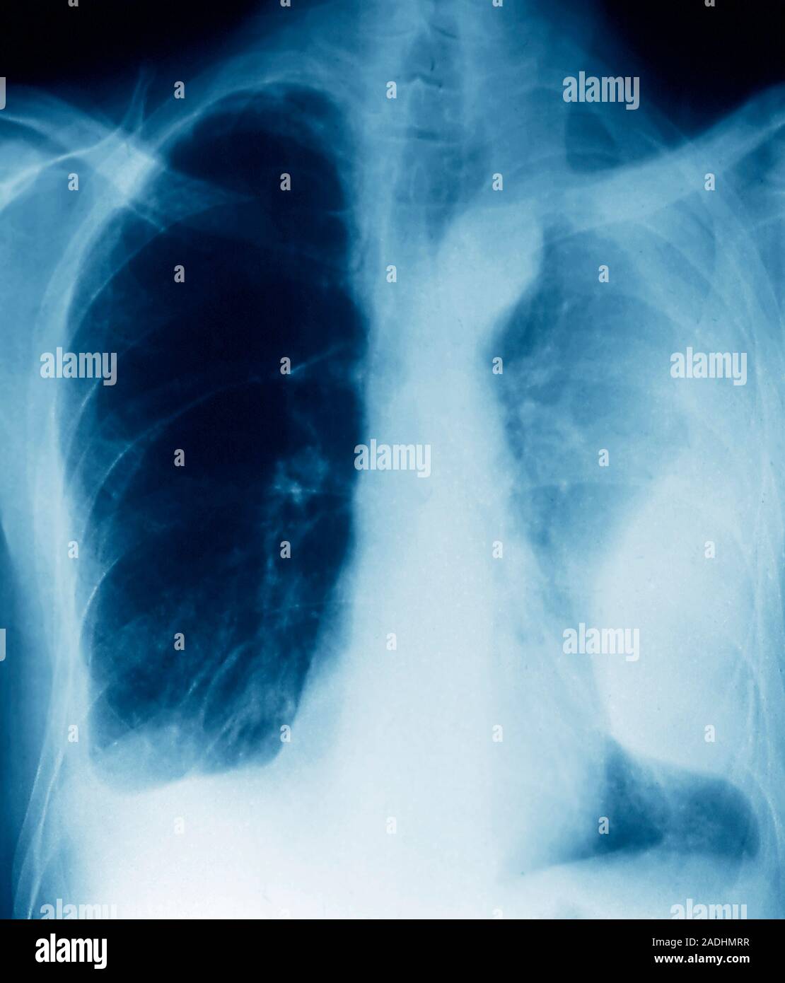 Pleurisy. Coloured Xray of the lungs of a patient with pleurisy