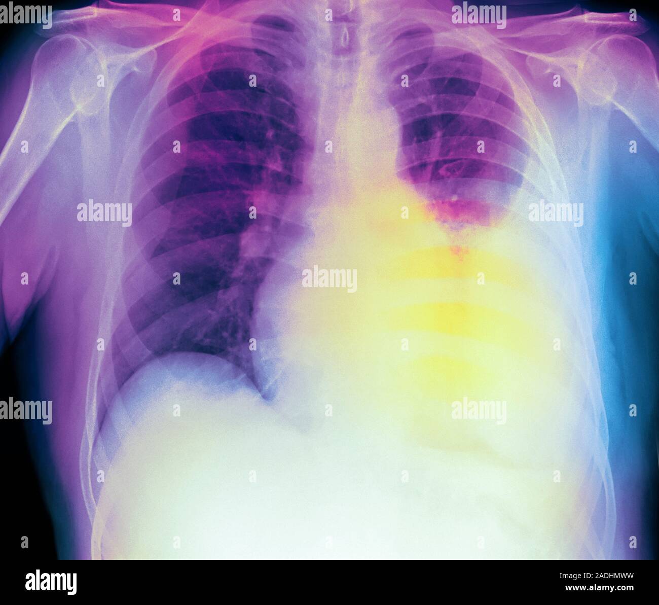 Pleural effusion. Coloured frontal Xray of the lungs of a male patient with a pleural effusions
