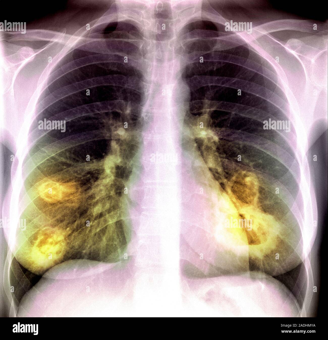 Lung lesion. Coloured frontal chest Xray of a woman with Wegener's