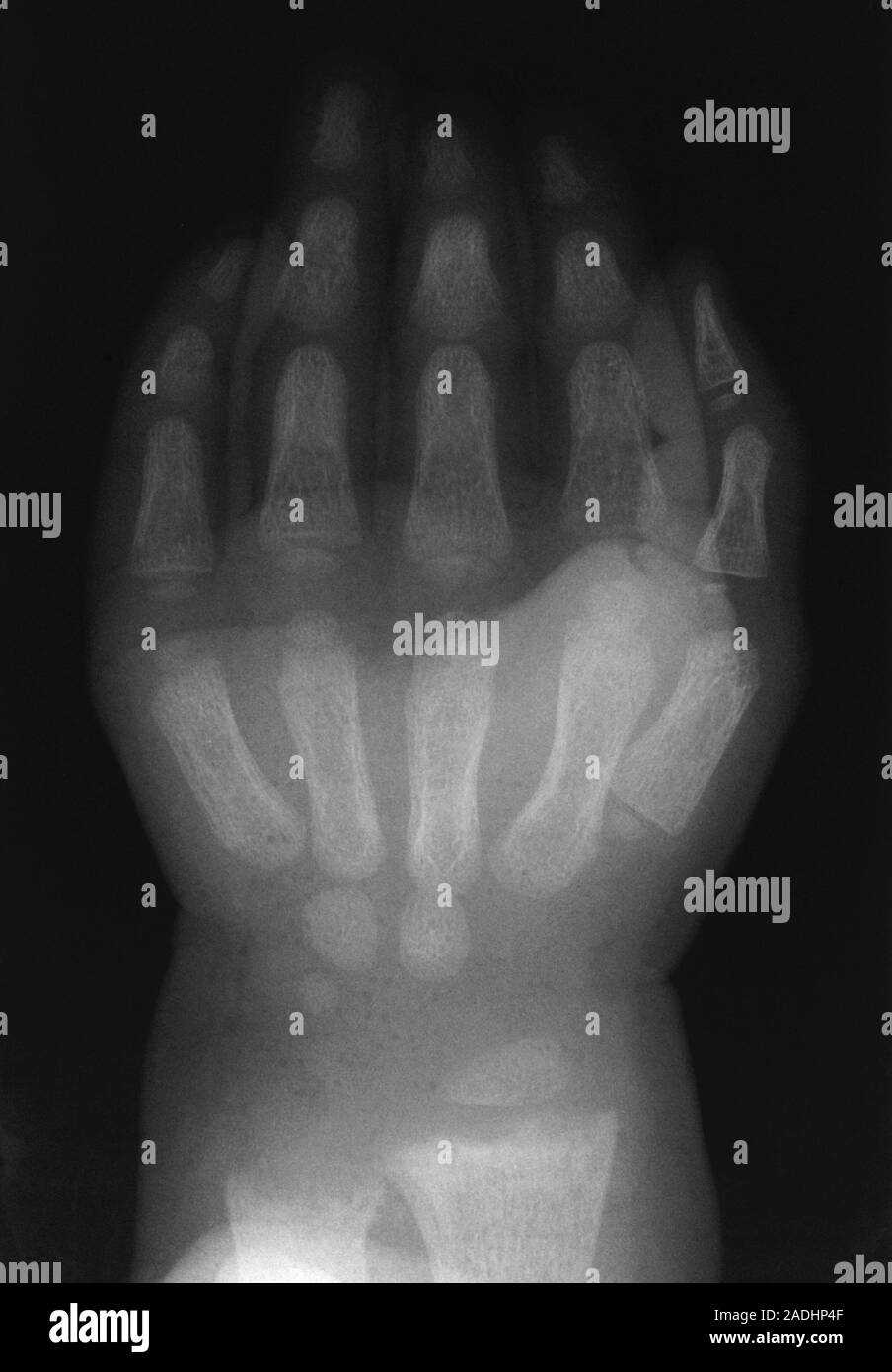 Rickets. Xray of the hand & wrist of a child suffering from rickets
