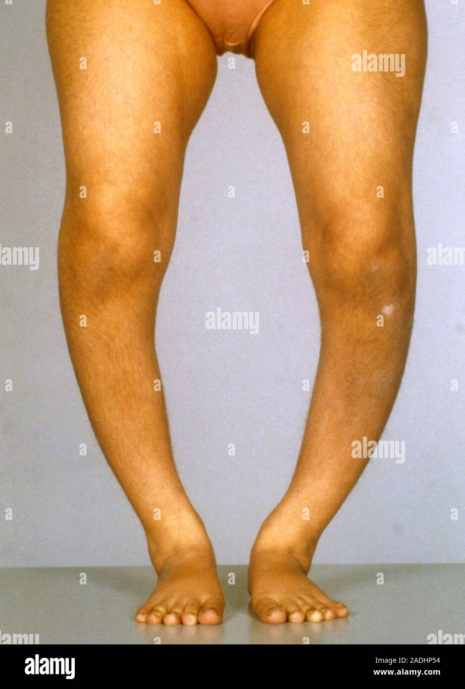 Rickets. Front view of the bowed legs of a patient due to rickets, a ...