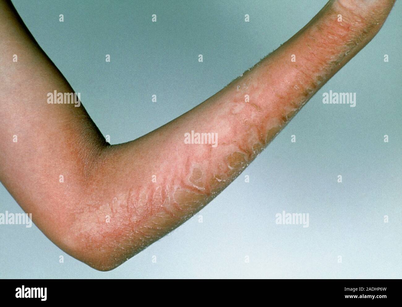 Scarlet fever rash on the arm of a young patient. Scarlet fever is a ...