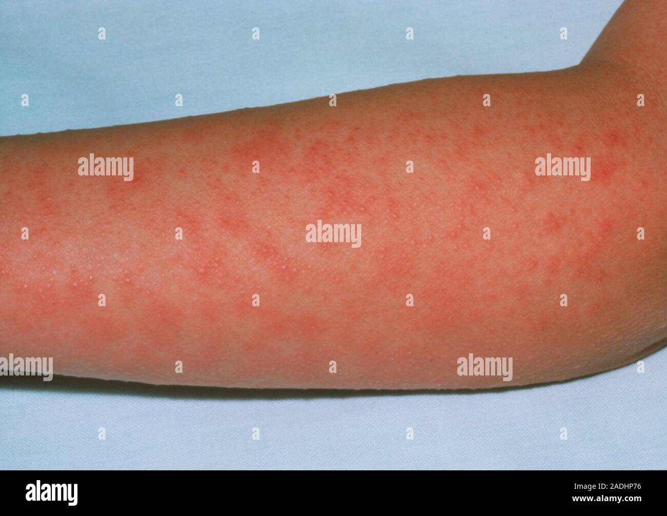 Scarlet Fever Rash On The Arm Of A Young Patient Scarlet Fever Is A scarlet-fever-rash-on-the-arm-of-a-young-patient-scarlet-fever-is-a