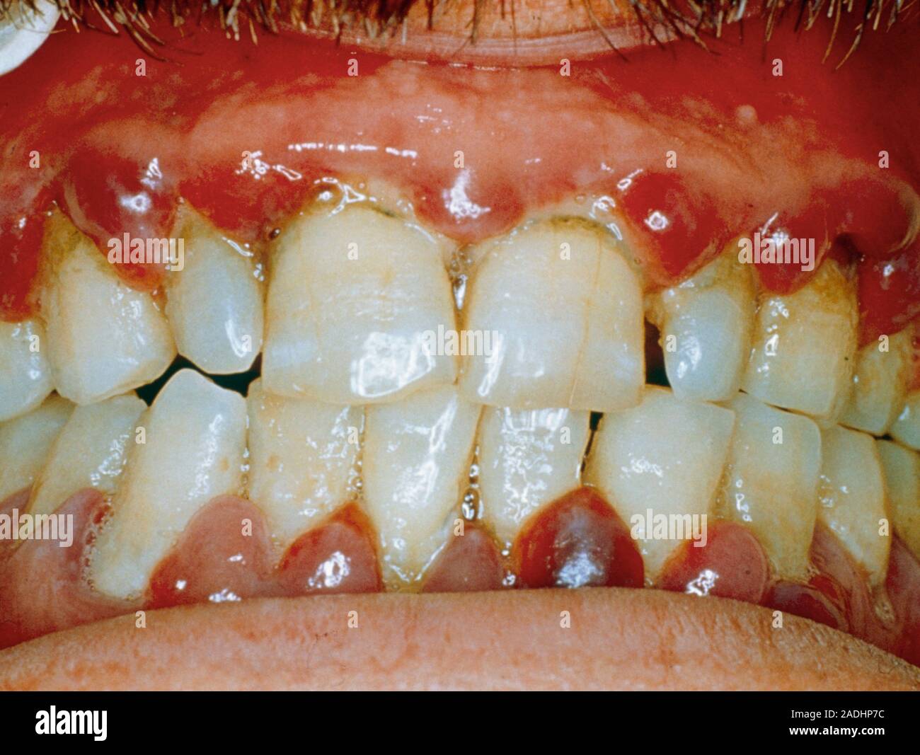 Scurvy. Clinical photograph of the mouth of a person suffering from scurvy, a disease caused by