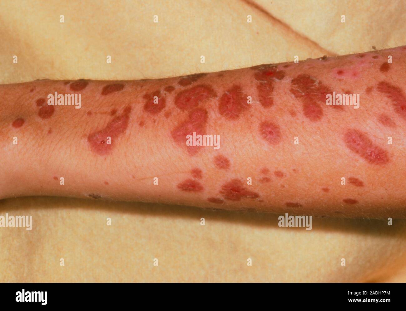 Morbilliform Rash Sjs Stevens-Johnson syndrome. Rash of red blisters on the arm of a person ...