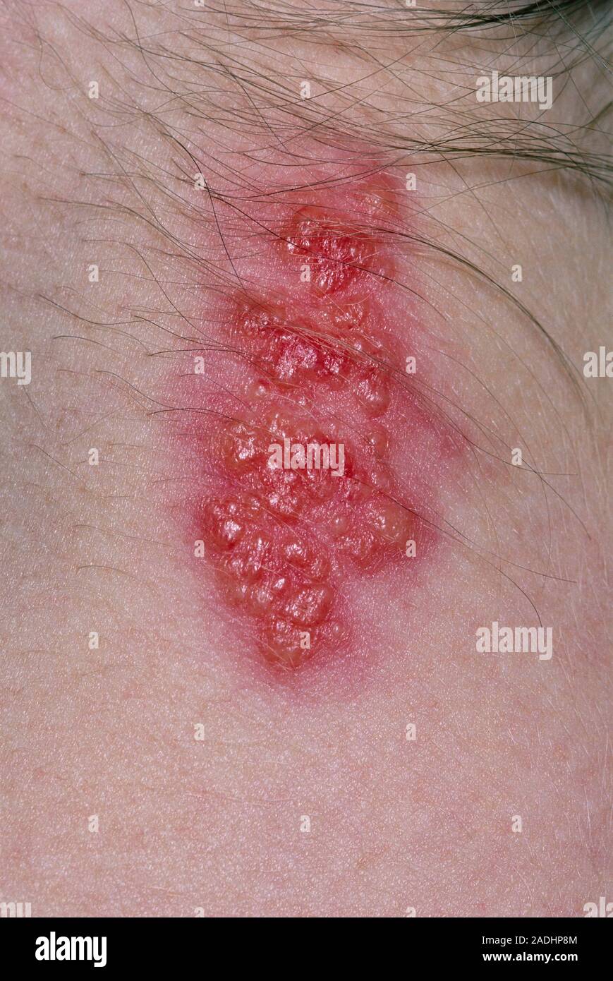 Herpes zoster. Closeup of shingles blisters on the back of a woman's