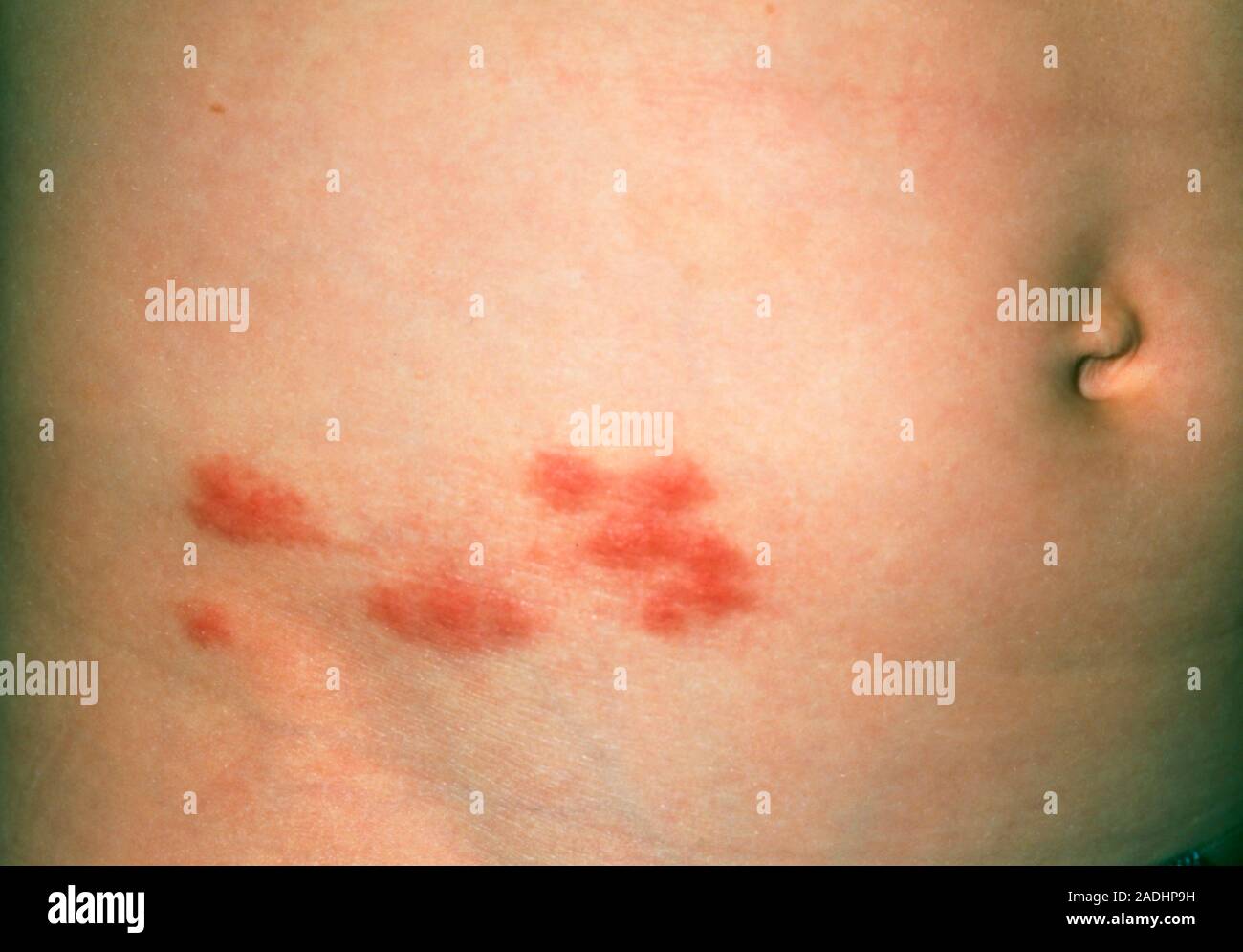 Shingles. Close-up of a herpes zoster (shingles) rash on the abdomen of ...