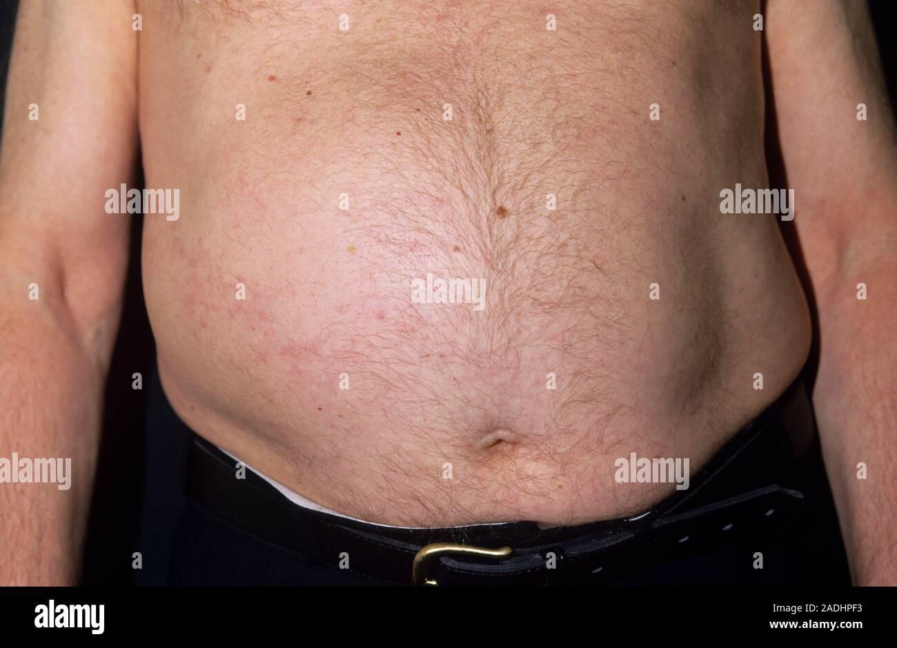 Upper abdominal muscle weakness after shingles (Herpes zoster
