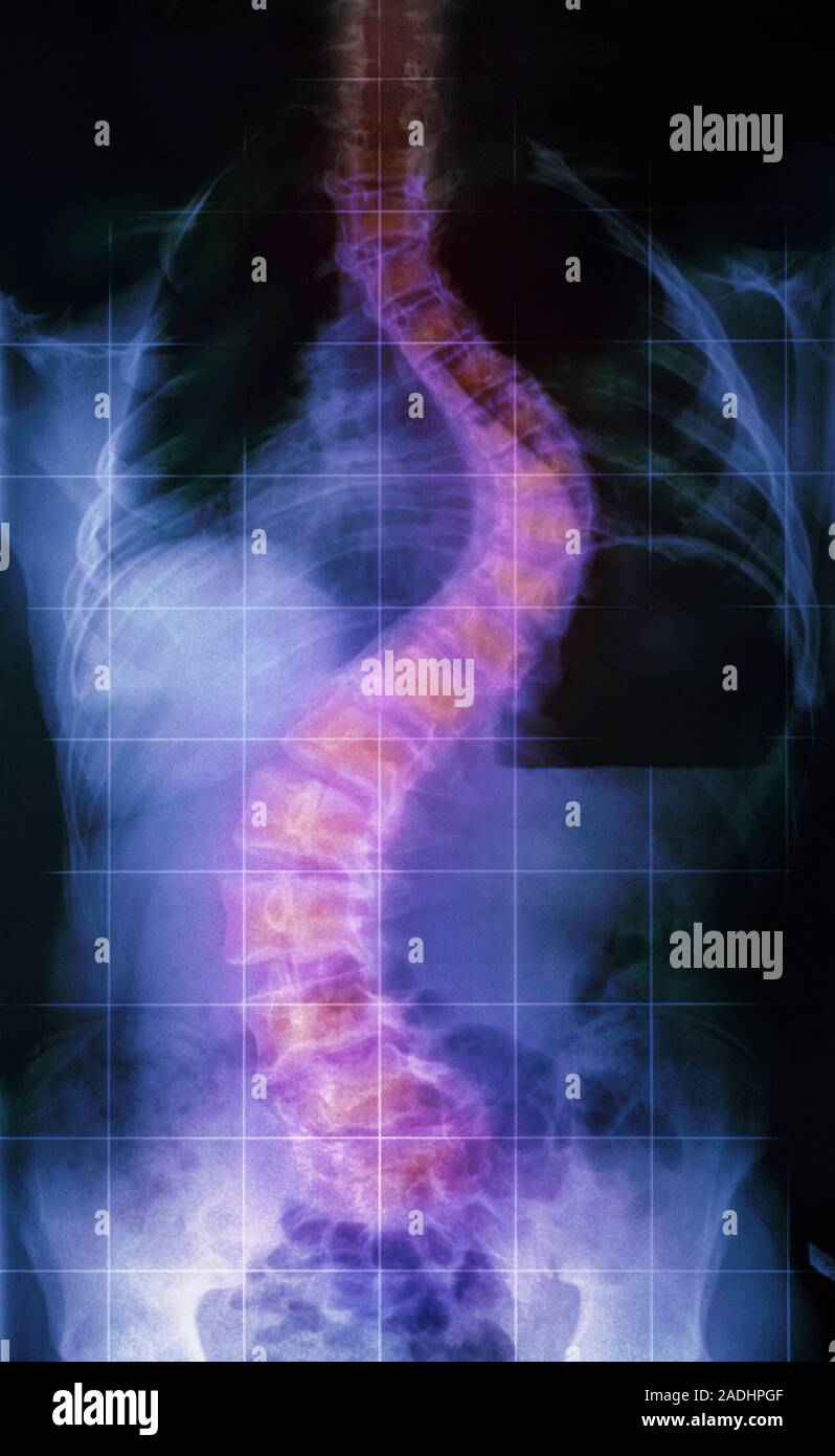 Scoliosis in Sotos syndrome, image 1 of 2. Coloured Xray of the curved spine (scoliosis) of a