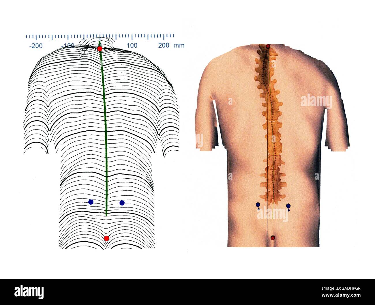 Scoliosis of the back. Computer artwork showing a dorsal (back) view of ...