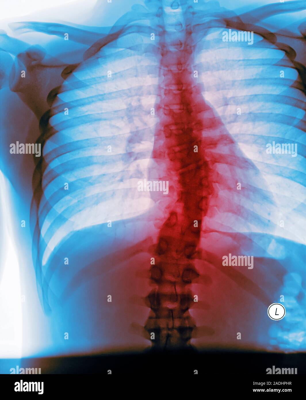 Curved spine. Coloured frontal Xray of the spine (centre) of a male