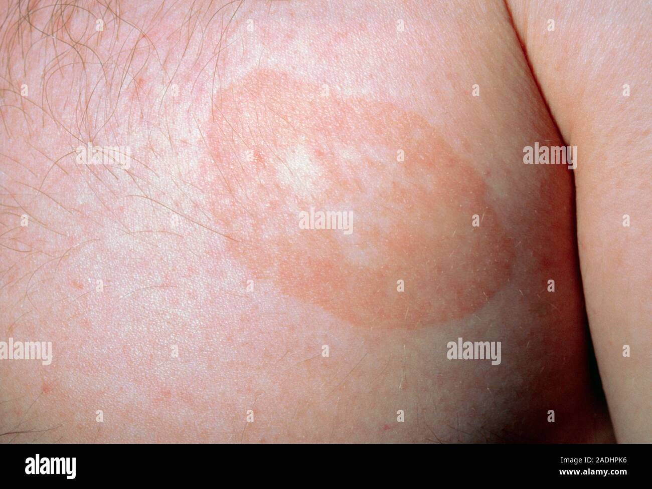 Ringworm of the body area, medical name tinea corporis. Ringworm is a fungal infection of the