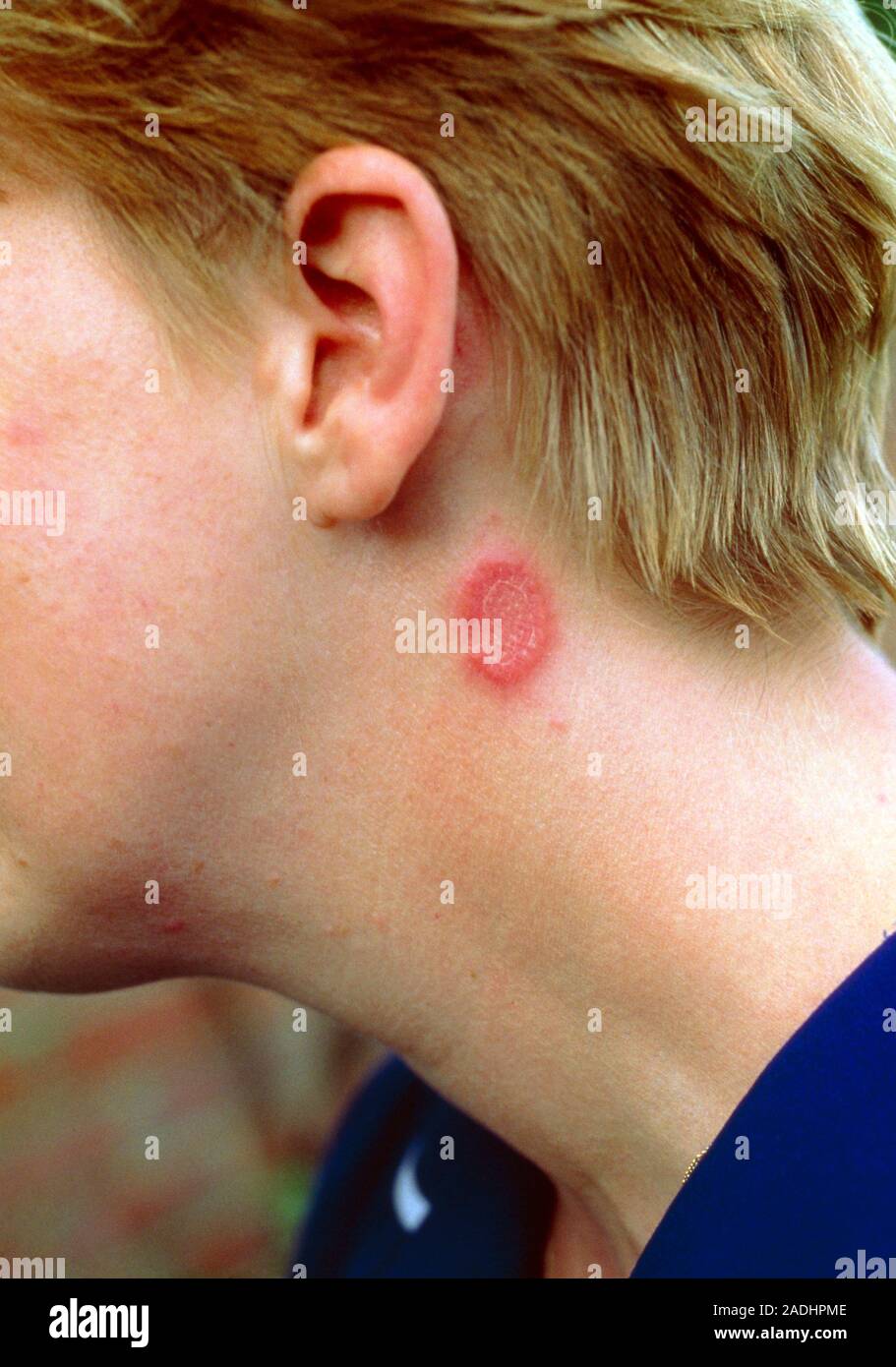 Ringworm. View of a red circular lesion caused by a fungal infection