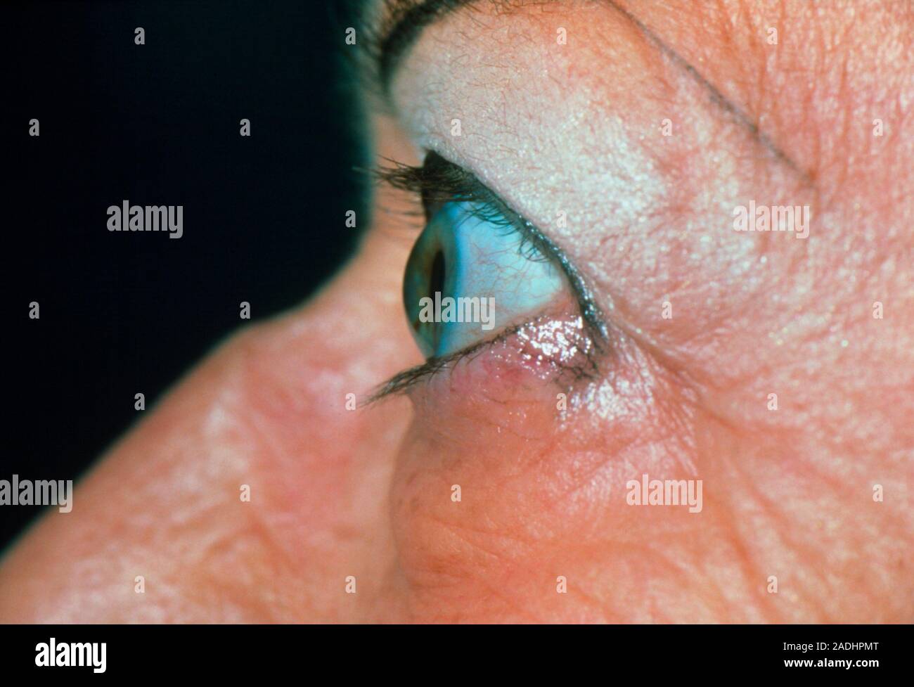 Eye in thyrotoxicosis. Side view of a bulging eye (exophthalmos) in an