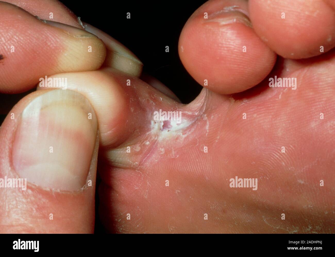 Athlete's foot. Closeup of athlete's foot affecting the skin between a