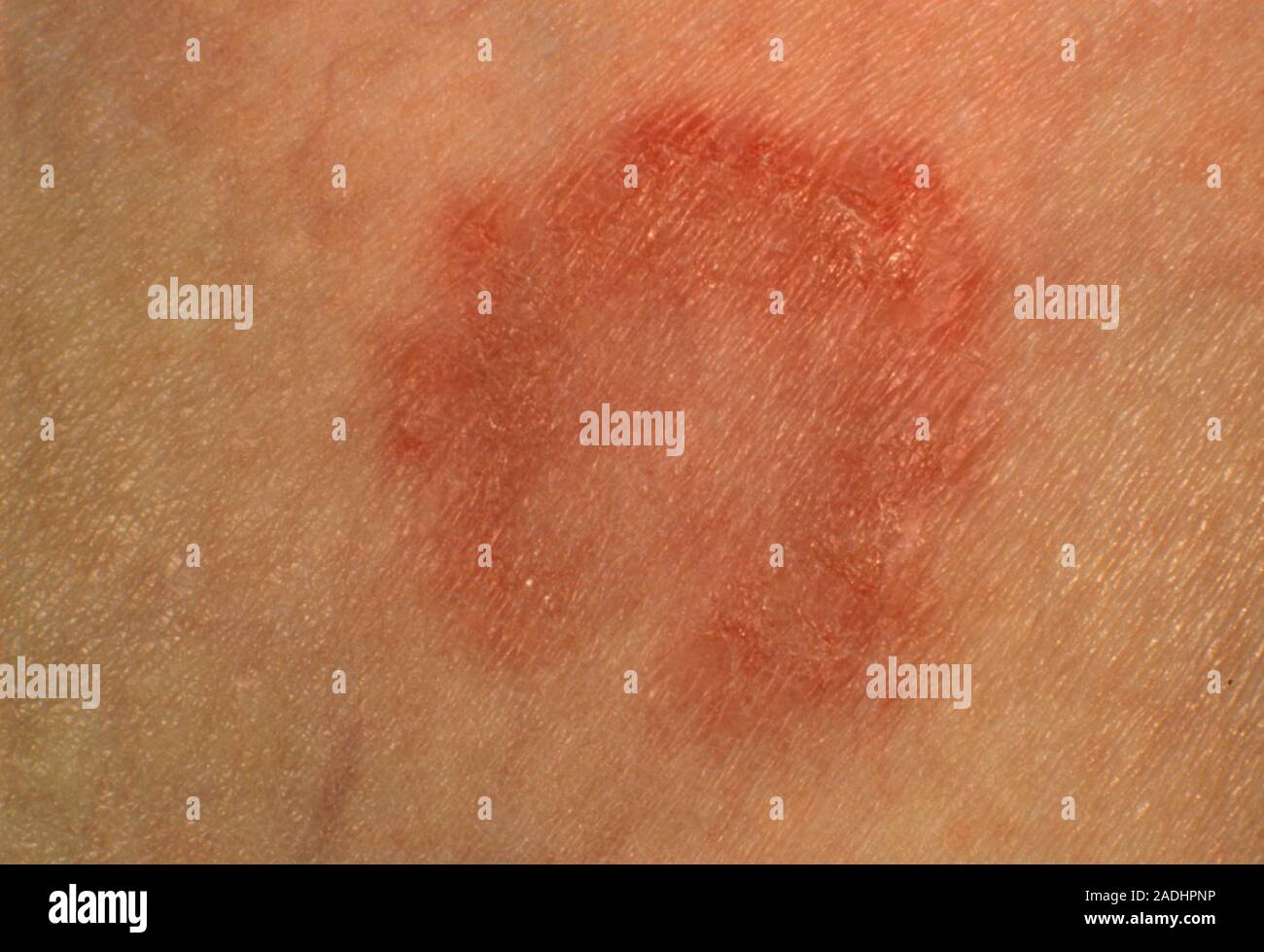 Ringworm lesion. Closeup of a single ringworm lesion, known as Tinea