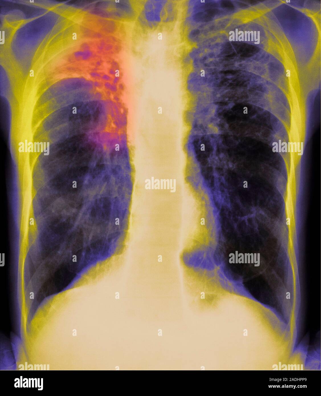 Tuberculosis. Coloured chest X-ray of a man with active pulmonary ...