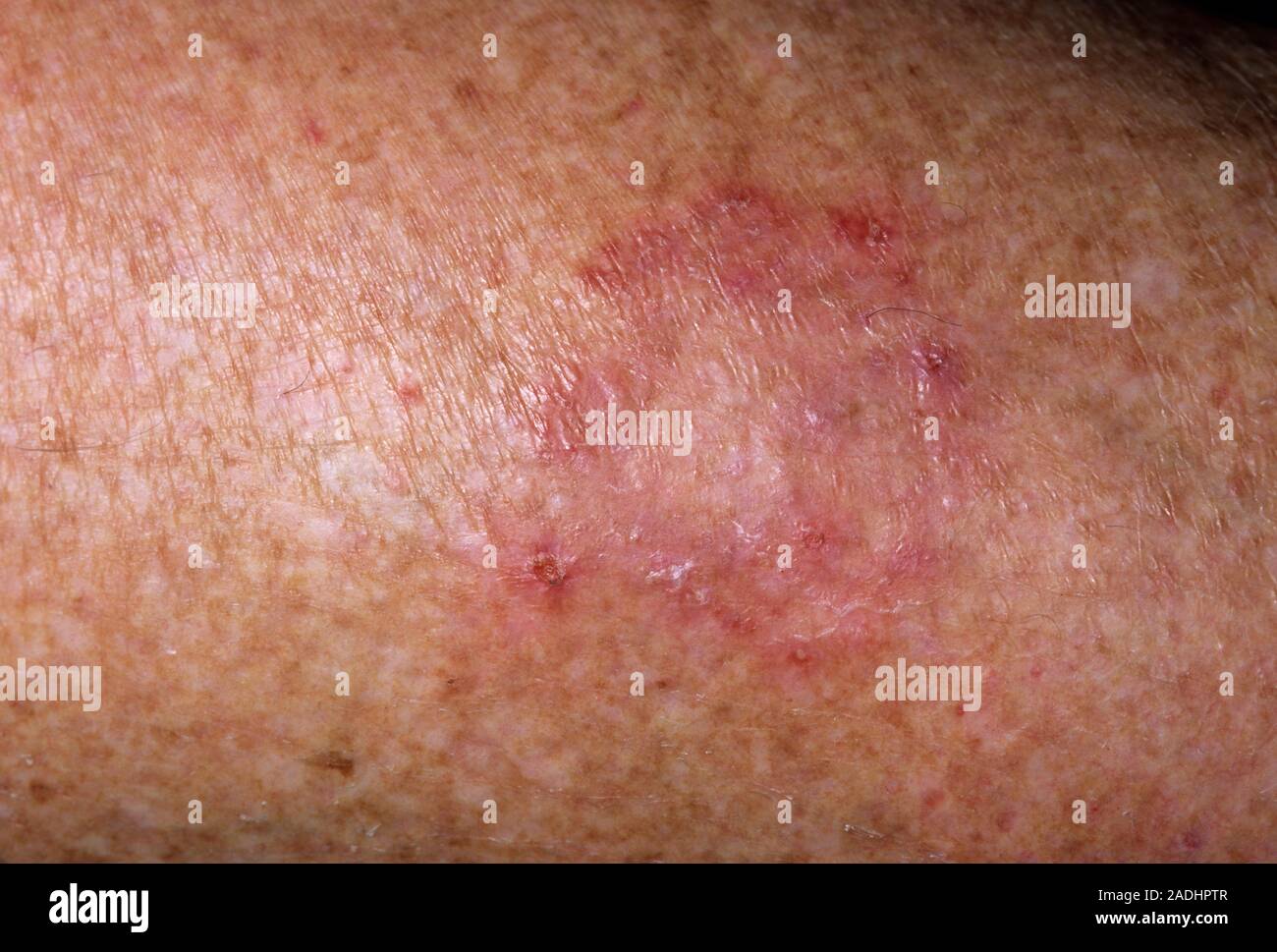 Ringworm infection on a 75yearold woman's leg. Ringworm (tinea) is a