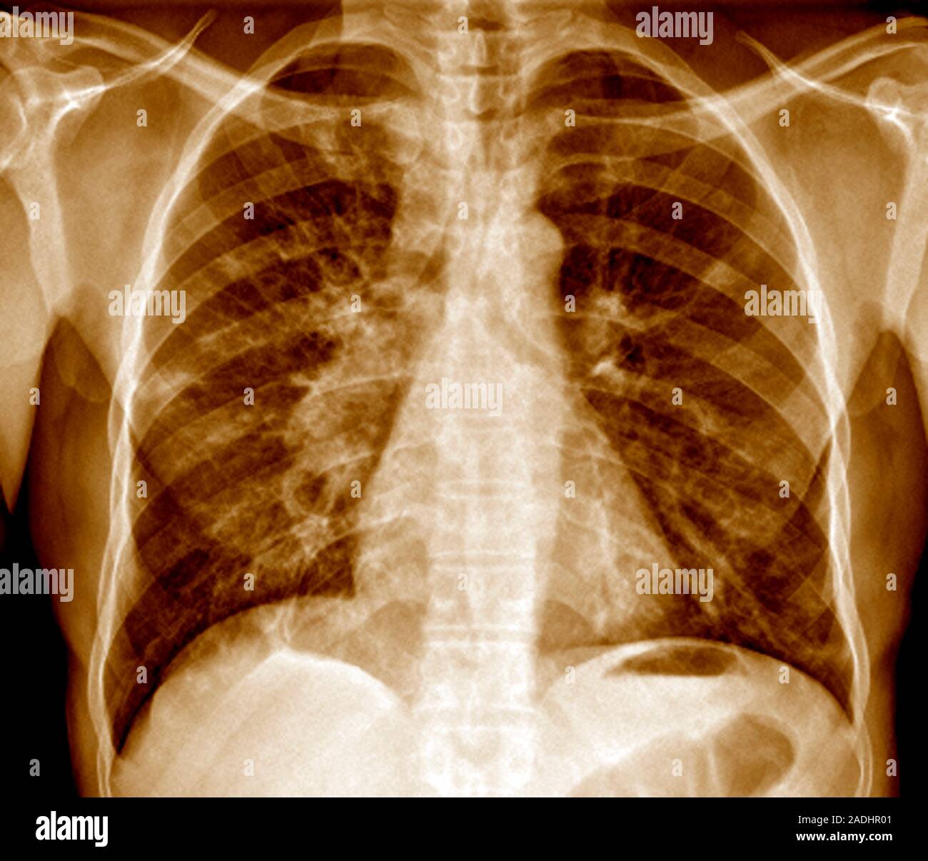 Рентген лёгких вейпера