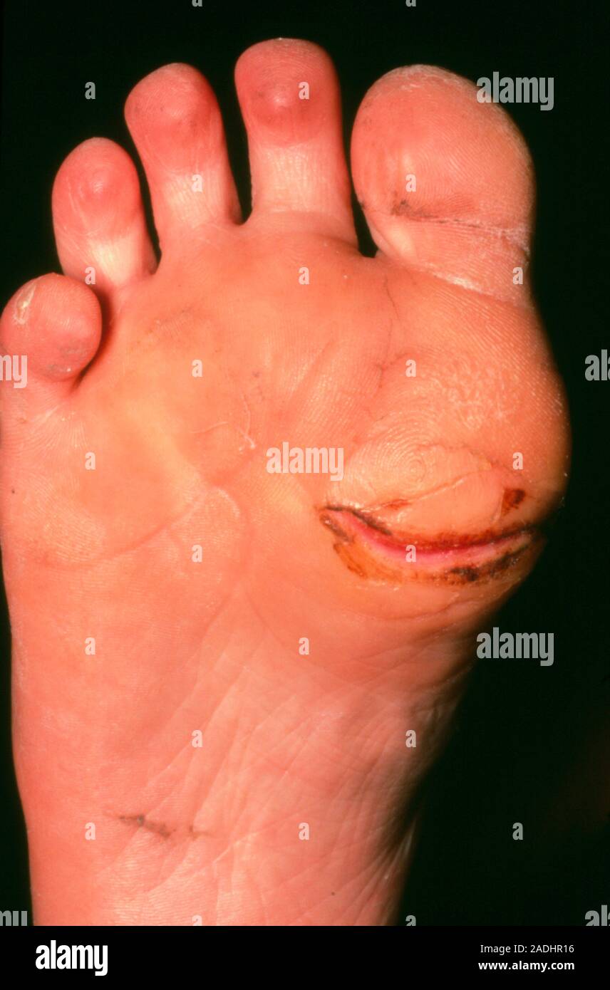 Ulceration of the sole of the foot due to diabetic neuropathy, a