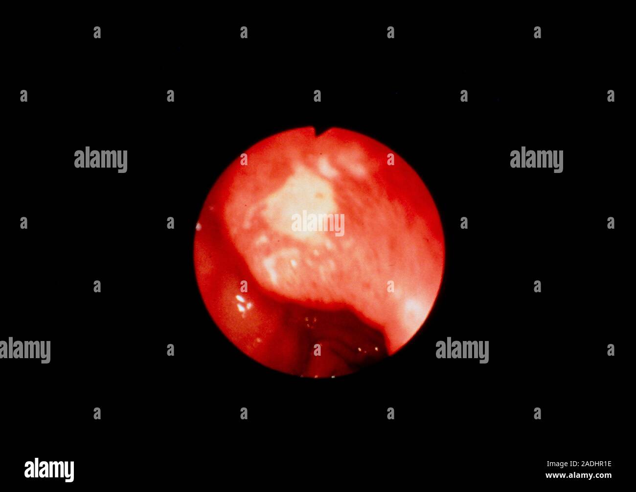 Endoscope image of an ulcer in the duodenal bulb, the upper part of the