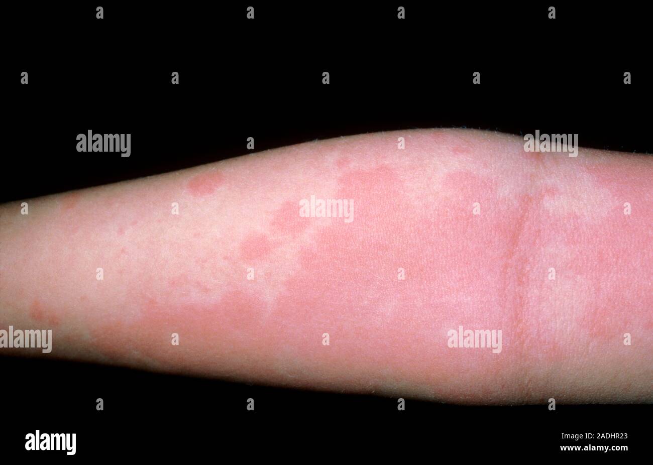 Acute urticaria affecting an arm. Also called hives or nettle rash, urticaria is a transient swelling and/or flushing of the skin. The underlying vaso Stock Photo