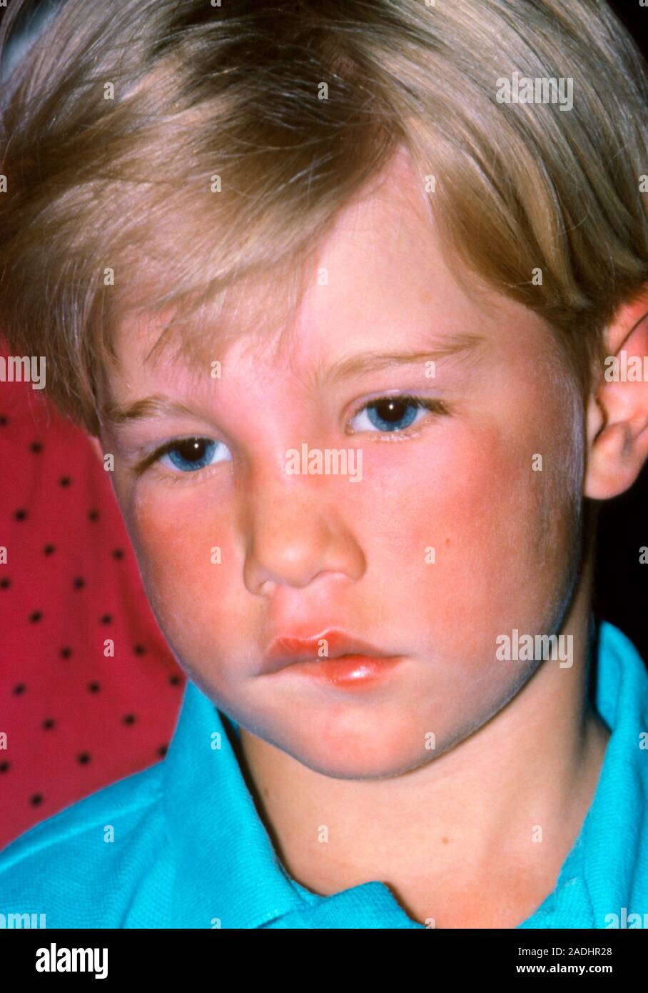 Skin disorder. Child affected by urticaria on his face, also known as