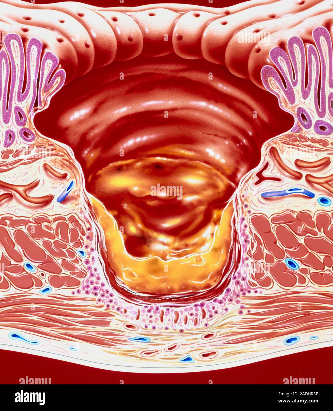 Слизистая оболочка 12 кишки. Язва 12 перстной кишки эндоскопия. Атлас эндоскопии язва желудка. Эрозия слизистой оболочки кишечника. Гигантская язва желудка.