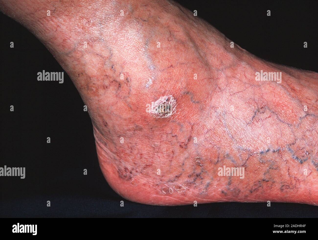 Arterial ulcer(centre, black, white-ringed) on a 66-year-old male ...