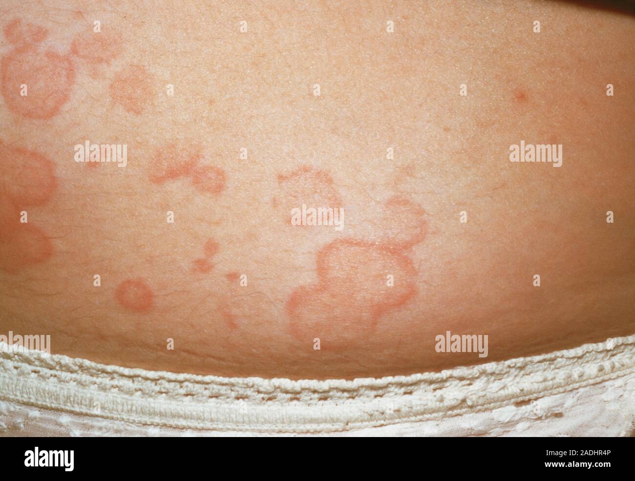 Urticaria rash on a patient's body. Also known as nettle rash or hives ...