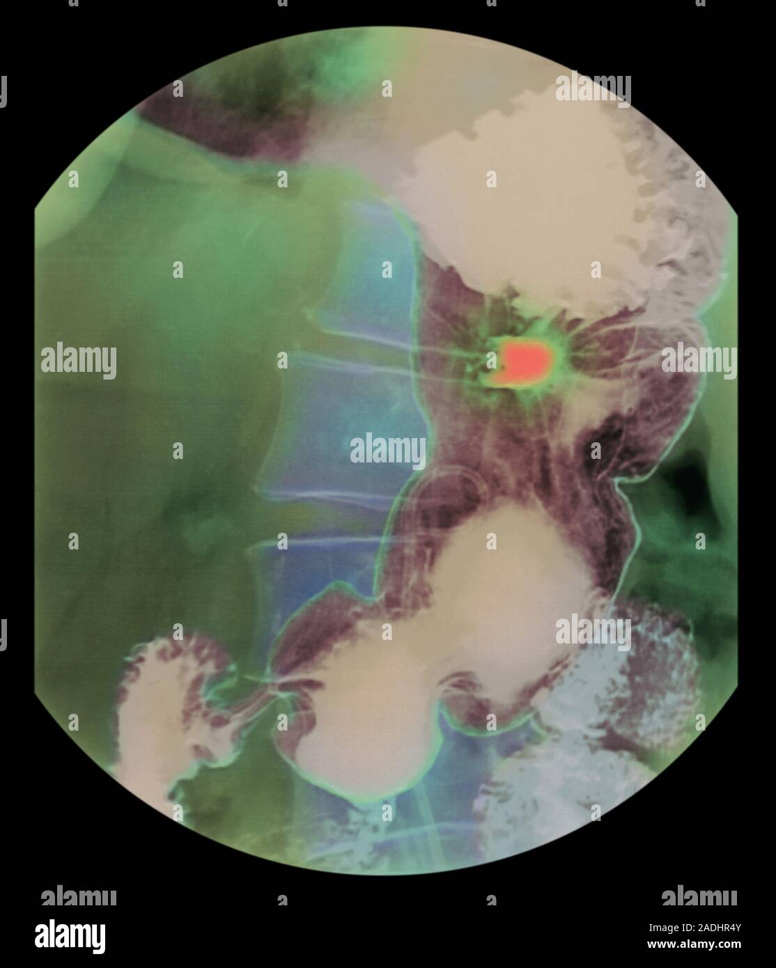 Stomach ulcer. Coloured barium Xray of a patient's stomach (brown) showing the position of a