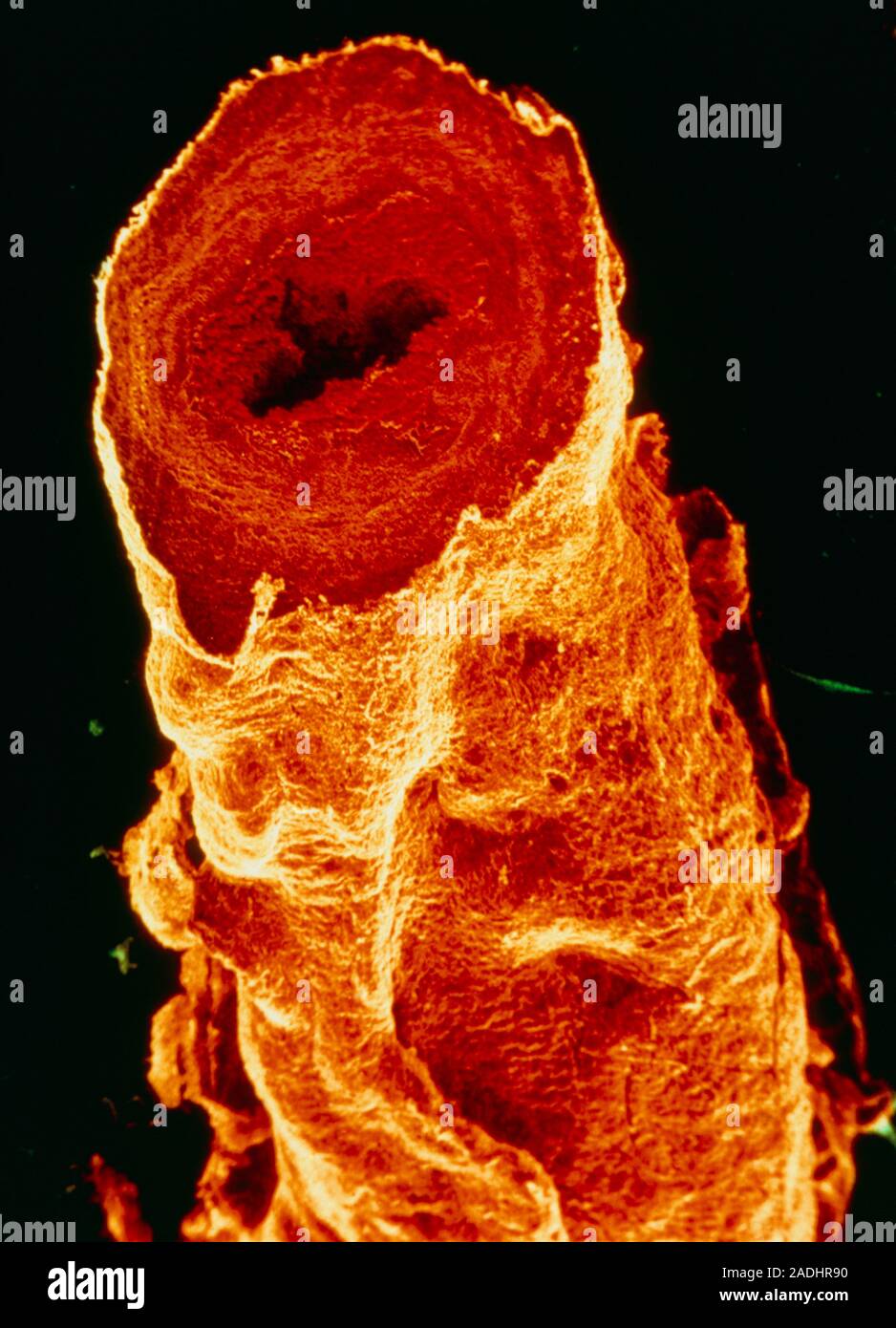 False-colour scanning electron micrograph (SEM) of a sectioned varicose ...